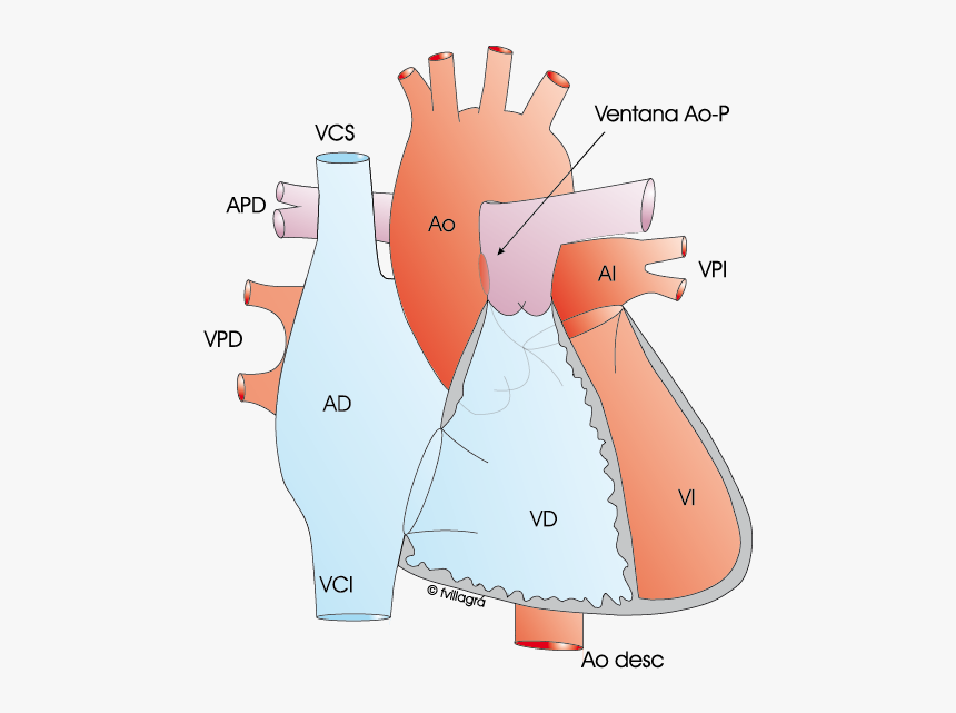 Tetralogy Of Fallot, HD Png Download, Free Download
