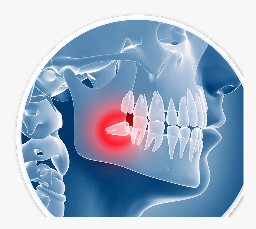 Impacted Wisdom Tooth - Dental Problems, HD Png Download, Free Download