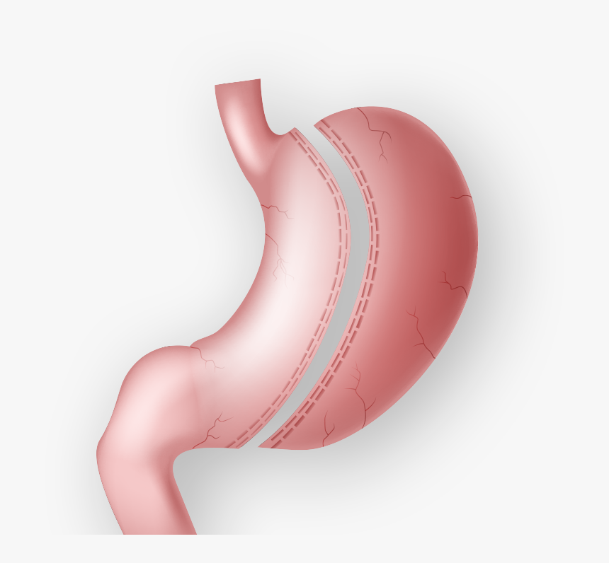 Demonstration Of Gastric Sleeve Surgery - Illustration, HD Png Download, Free Download