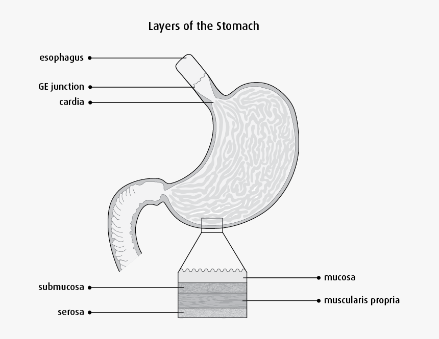 Stomach Carcinoma In Situ, HD Png Download, Free Download