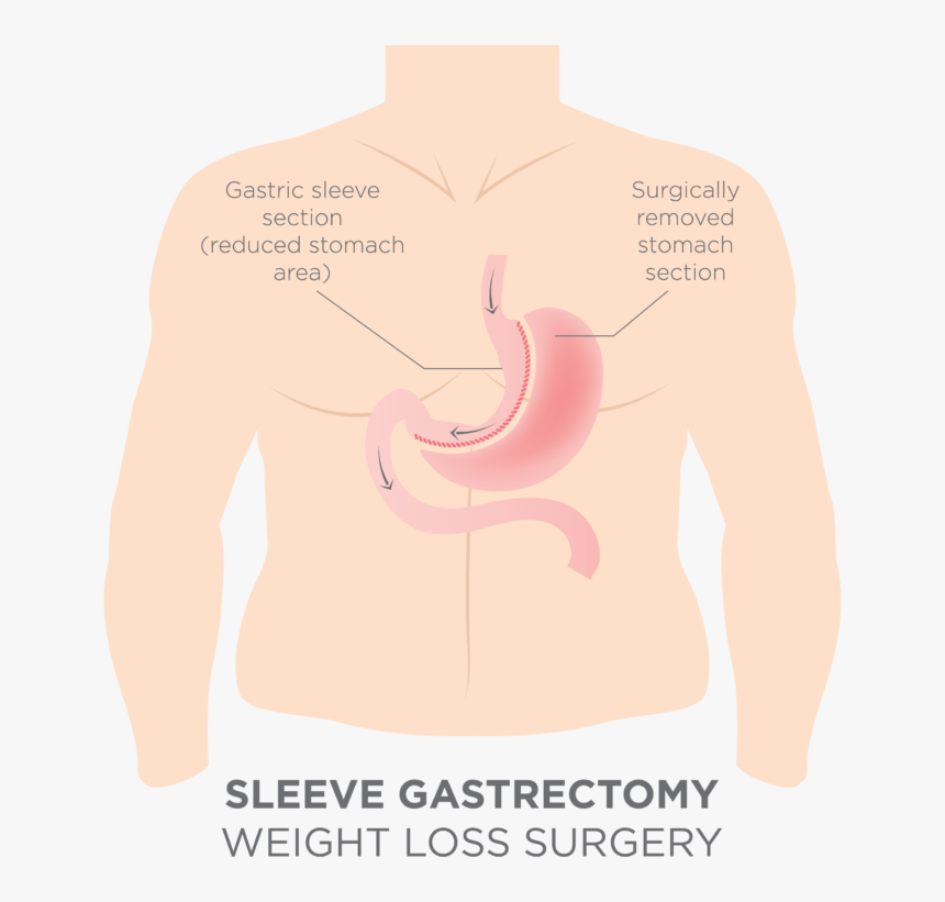 Gastric Sleeve Stomash Removal, HD Png Download, Free Download