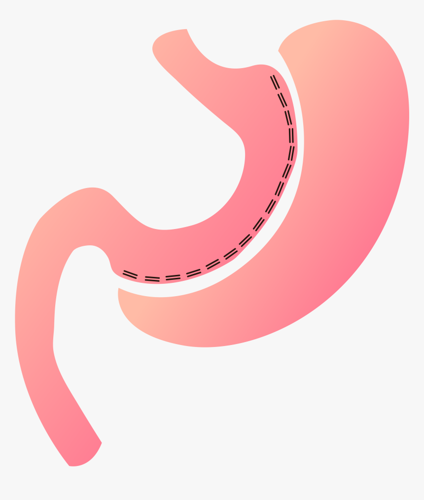 Artboard 46@300x - Gastric Sleeve Png, Transparent Png, Free Download
