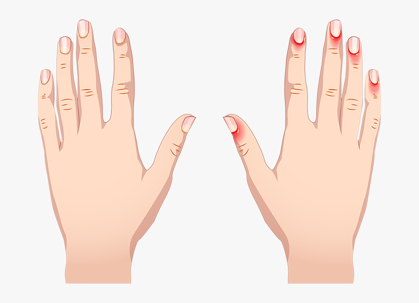Irritated Cuticles Hands - Cuticles Swollen And Itchy, HD Png Download, Free Download