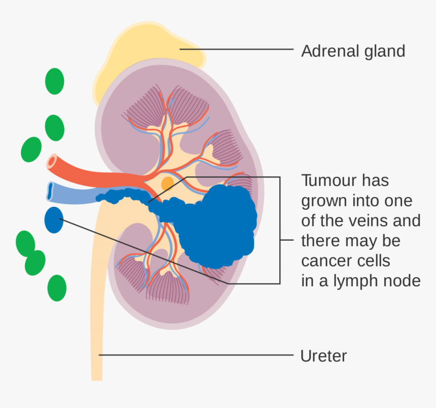 Kidney Cancer Surgery - Stage 1 Kidney Cancer, HD Png Download, Free Download