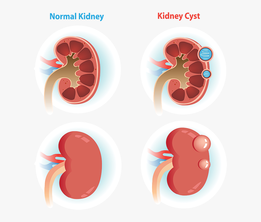 Comparison Of Normal Kidney Verse A Kidney With A Cyst - Kidney Cyst, HD Png Download, Free Download