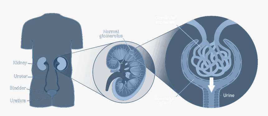 Fabry Disease Renal Symptoms Graphical Image - Renal Failure Fabry, HD Png Download, Free Download