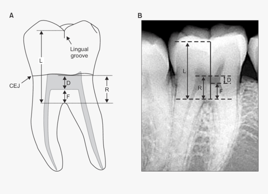 Lingual Aspect Of Mandibular First Molar, HD Png Download, Free Download