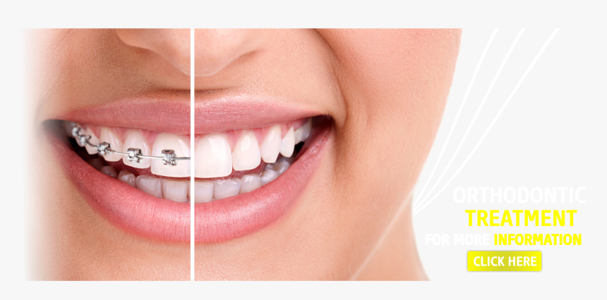 Braces With Straight Teeth, HD Png Download, Free Download