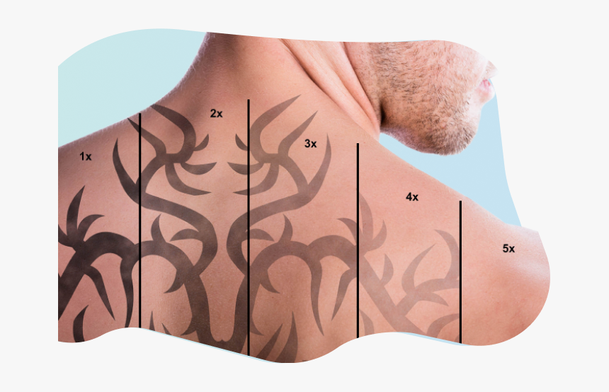 Man Tattoo Laser Removal, HD Png Download, Free Download