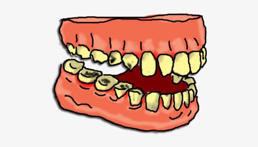 Teeth Clipart Dental Cleaning - Tooth Decay Clip Art, HD Png Download, Free Download