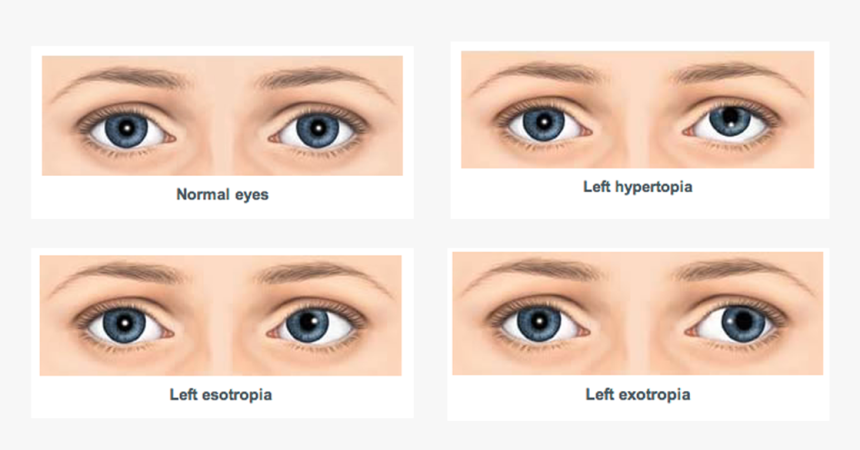 What Is Squint Or Strabismus - Squint In Eyes, HD Png Download, Free Download