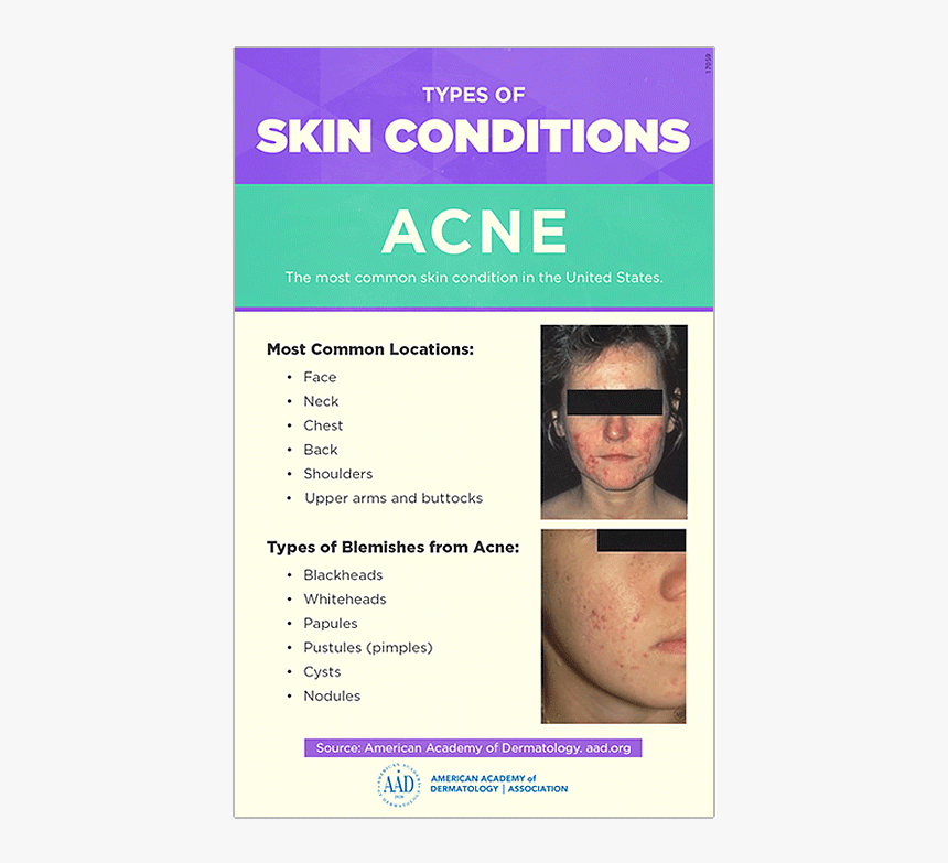 Acne Png, Transparent Png, Free Download