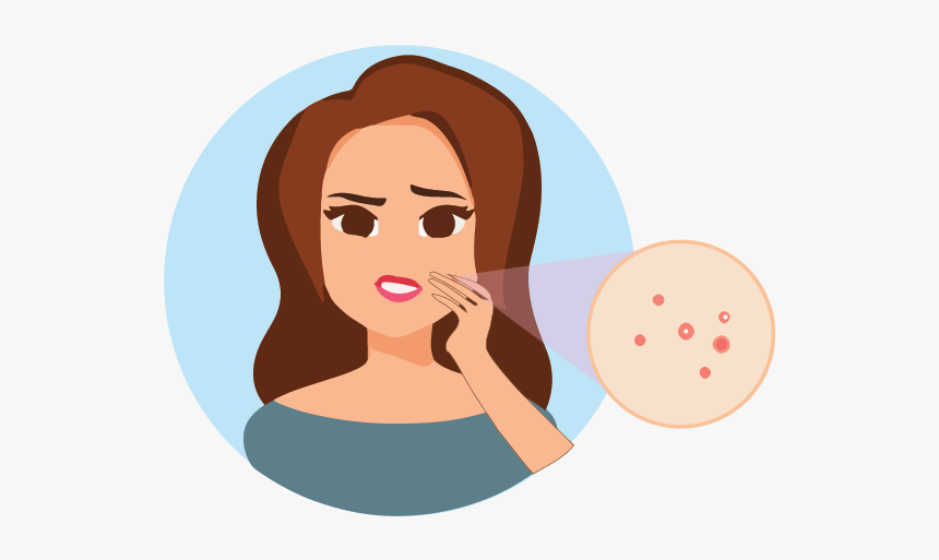 Acne Png, Transparent Png, Free Download