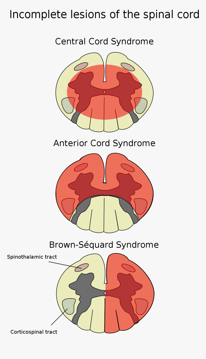 File - Cord-en - Incomplete Spinal Cord Lesions, HD Png Download, Free Download