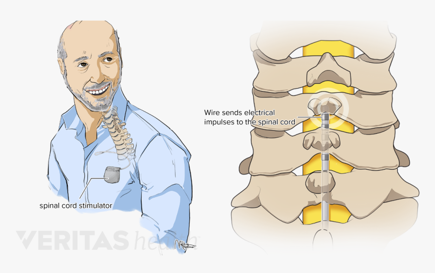 Illustration Of An Implanted Spinal Cord Stimulator - Intrathecal Pain Pump, HD Png Download, Free Download