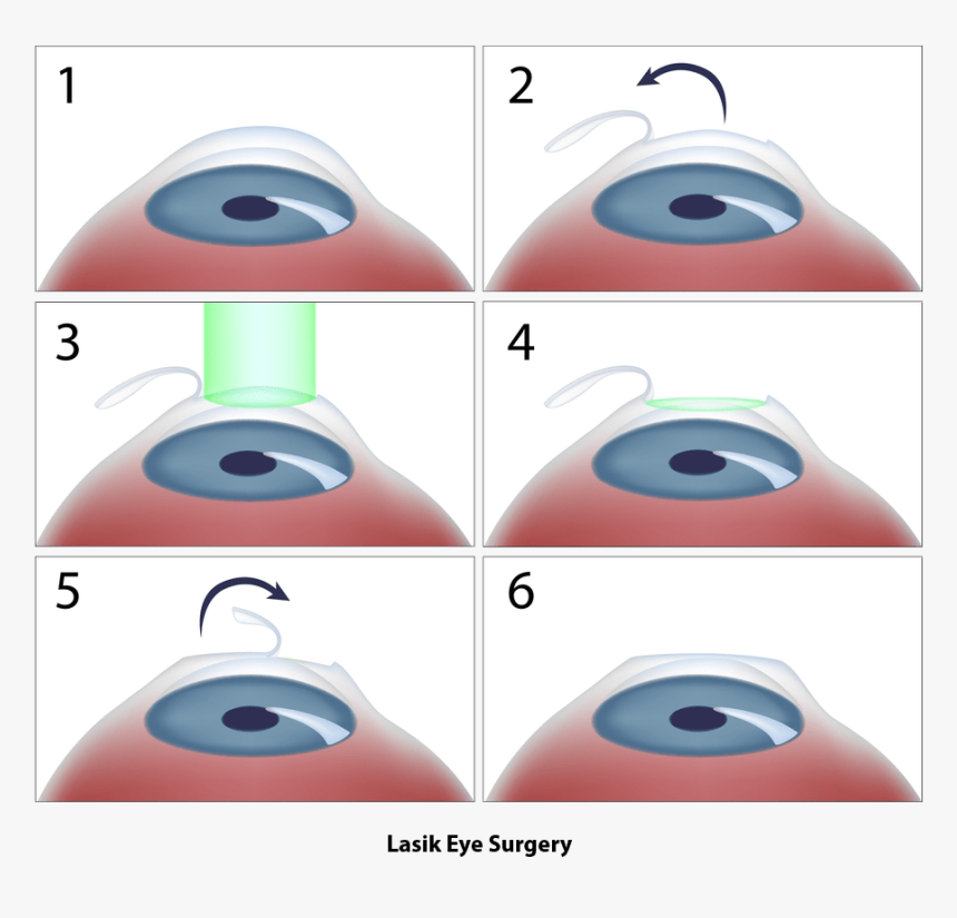 Lasik Procedure Flap - Lézeres Szemműtét, HD Png Download, Free Download