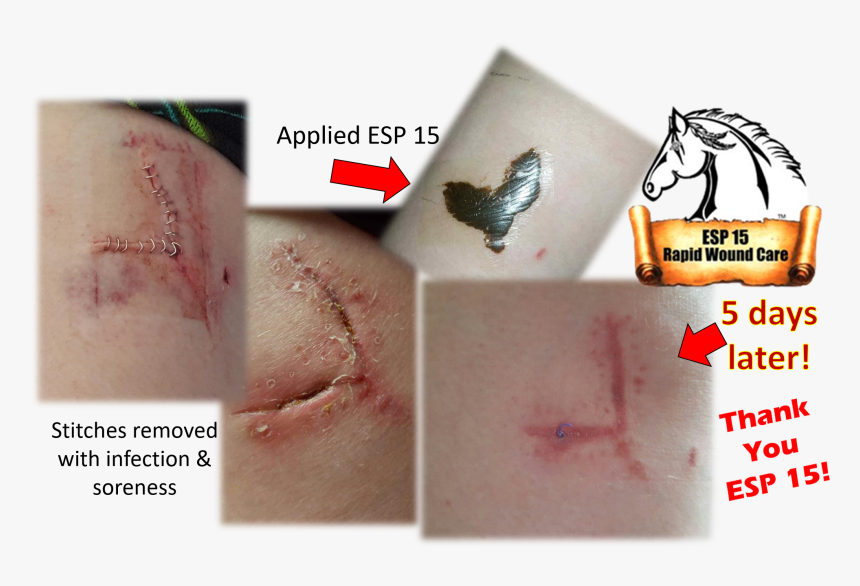 Esp 15 Used On A Infected Stitches - Scar, HD Png Download, Free Download