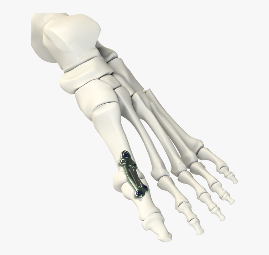 Mpj Implant System - Hand, HD Png Download, Free Download