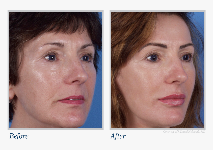 Now Available To The General Public - Laser Skin Treatment Before And After, HD Png Download, Free Download