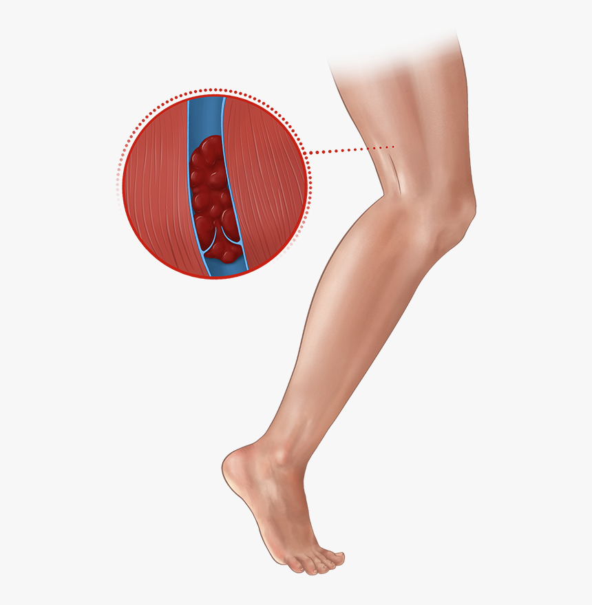 Deep Vein Thrombosis Png, Transparent Png, Free Download