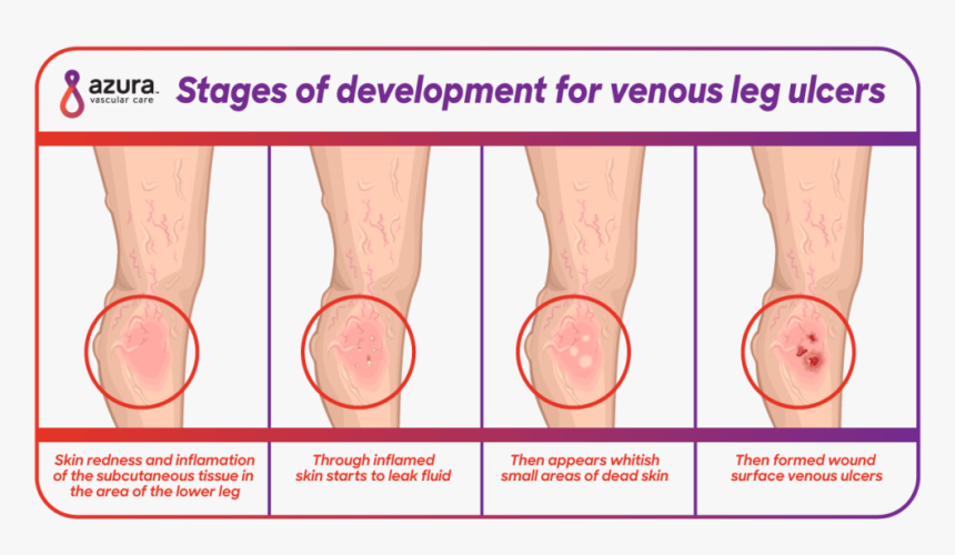 Stages Of Developement For Venous Leg Ulcers - Early Stage Venous Leg Ulcer, HD Png Download, Free Download