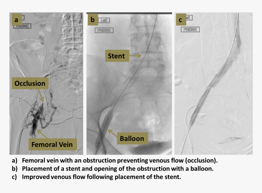 Venous Thrombolysis Recanalization Original - Spur, HD Png Download, Free Download