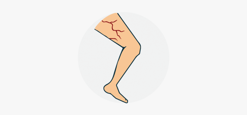 Varicose Vein And Ayurveda- - Illustration, HD Png Download, Free Download