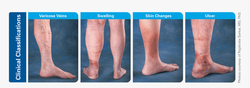 Chronic Venous Insufficiency, HD Png Download, Free Download