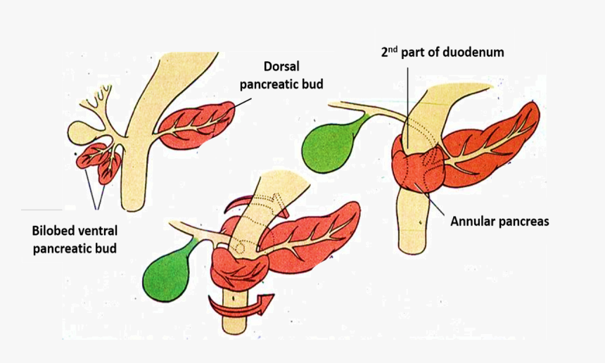 Pancreas - Annular - Annular Pancreas Vs Normal, HD Png Download, Free Download