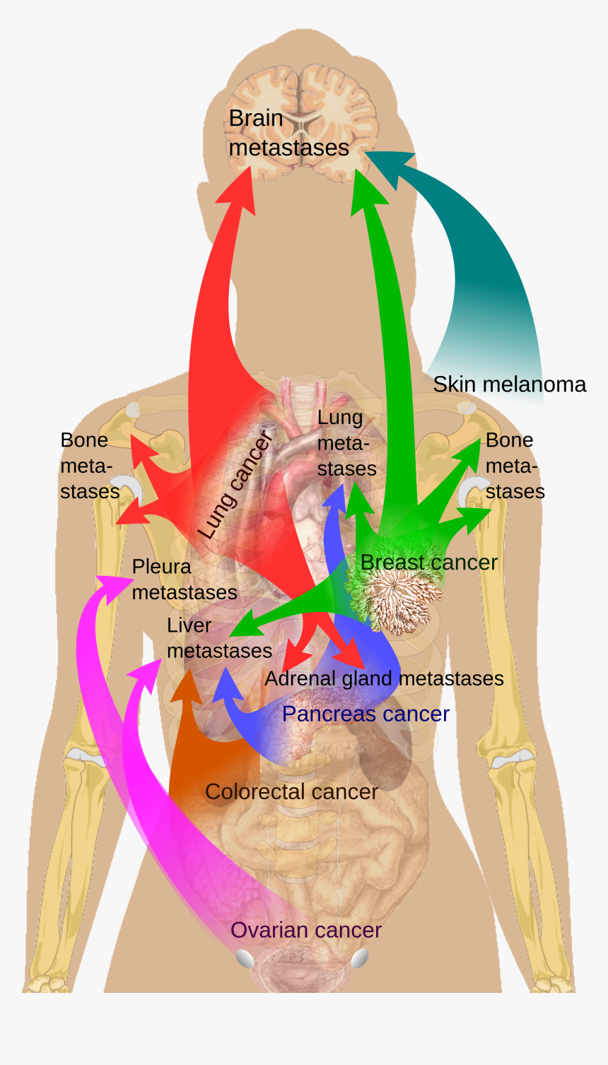 Common Metastatic Sites, HD Png Download, Free Download