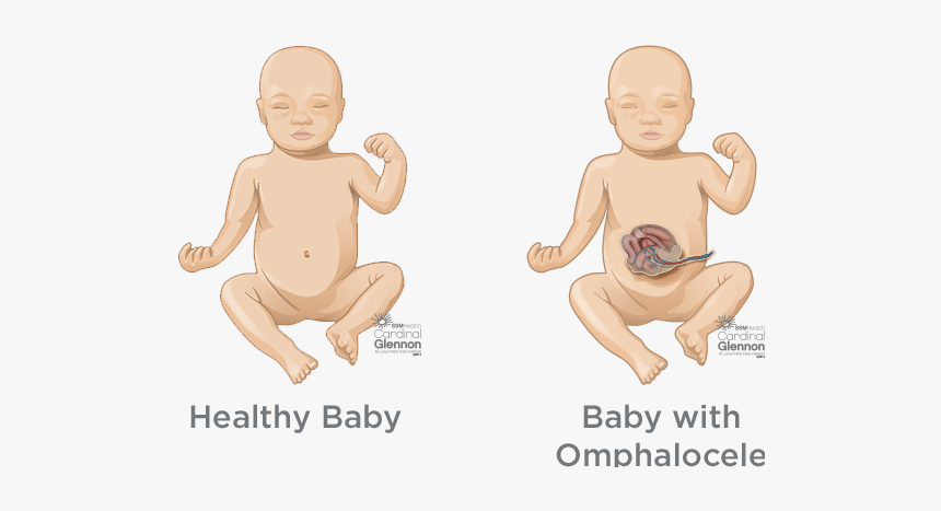 Omphalocele - Bladder Outlet Obstruction, HD Png Download, Free Download