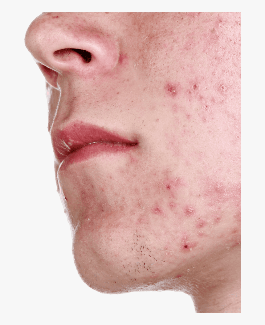 Close Up Of Acne On Man"s Chin - Bcaa Side Effects, HD Png Download, Free Download