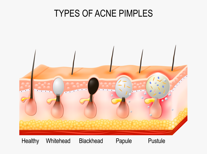 Types Of Acne Cartoon, HD Png Download, Free Download