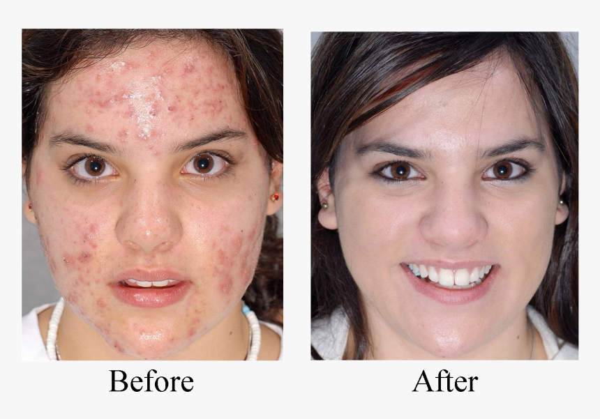Castor Oil Before And After Skin, HD Png Download, Free Download