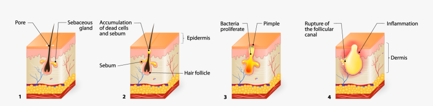 Inside A Pimple, HD Png Download, Free Download