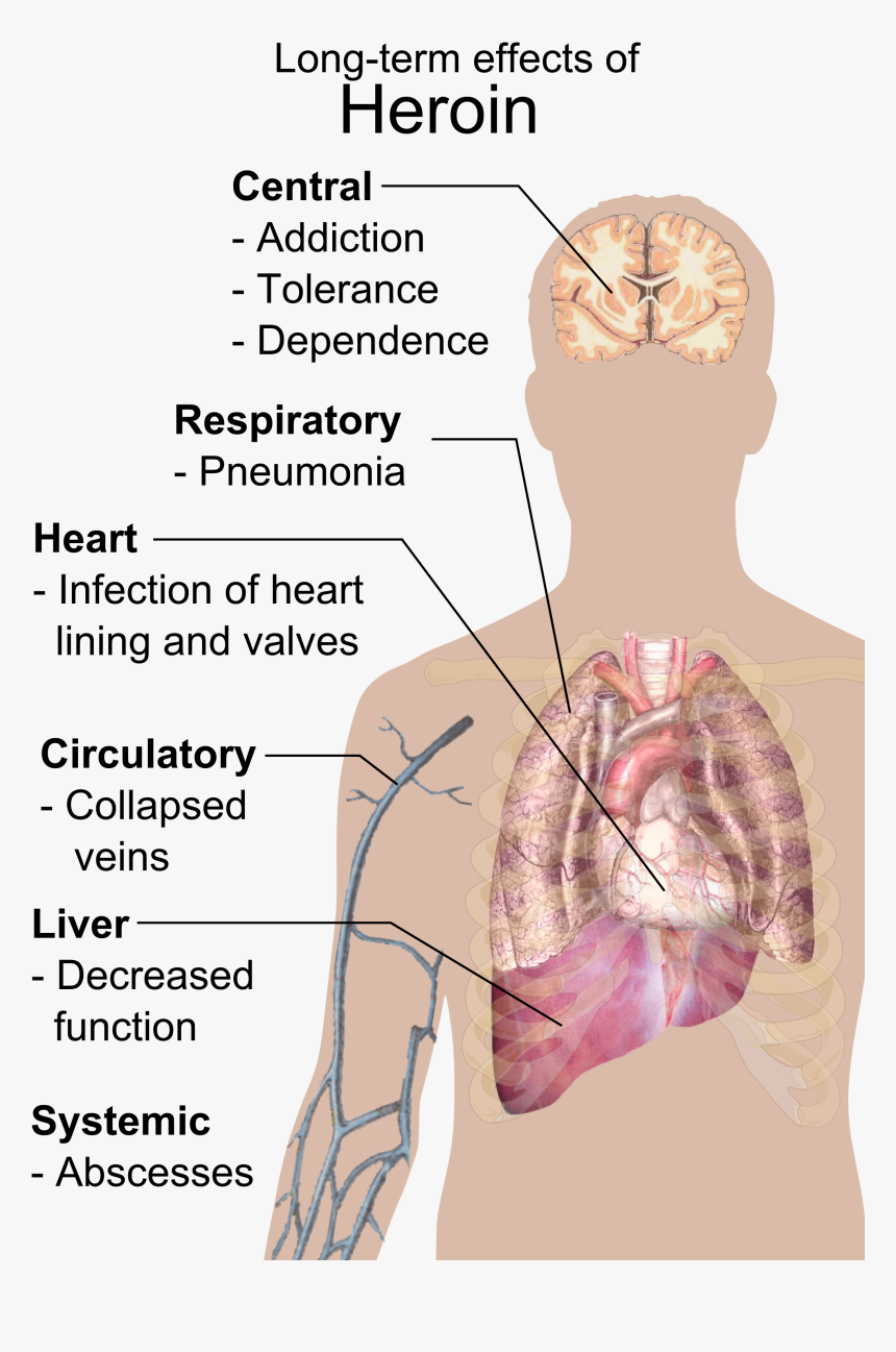 Long-term Effects Of Heroin - Long Term Effects Of Heroin, HD Png Download, Free Download