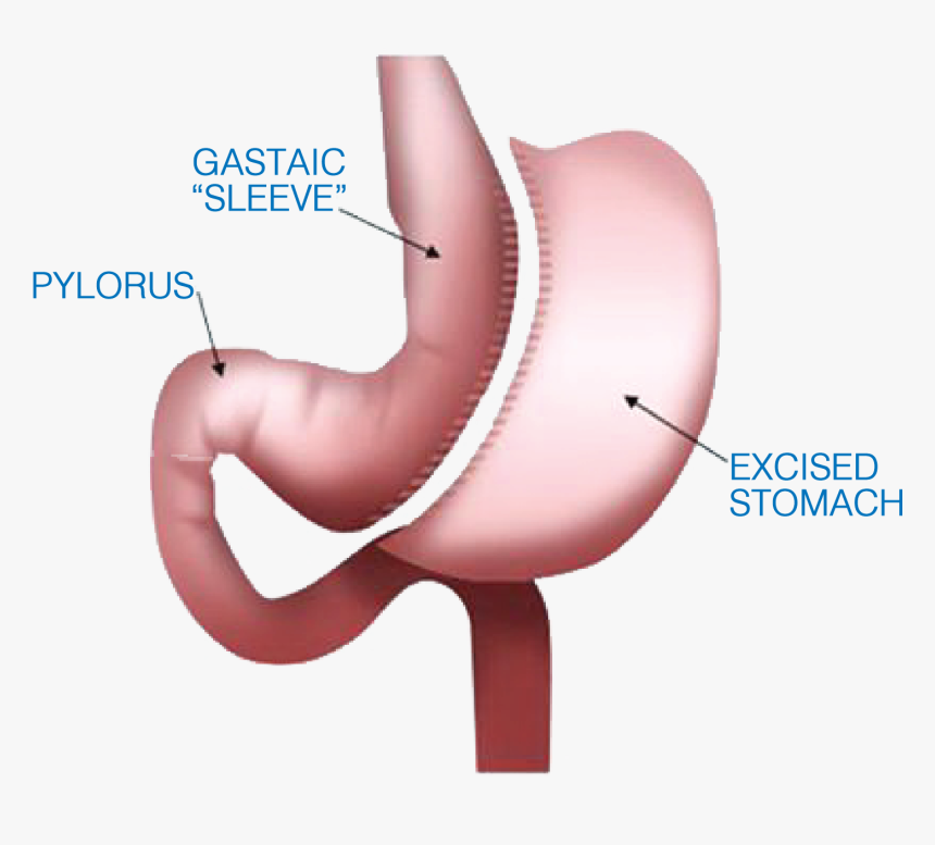 Weight Loss Procedures, HD Png Download, Free Download