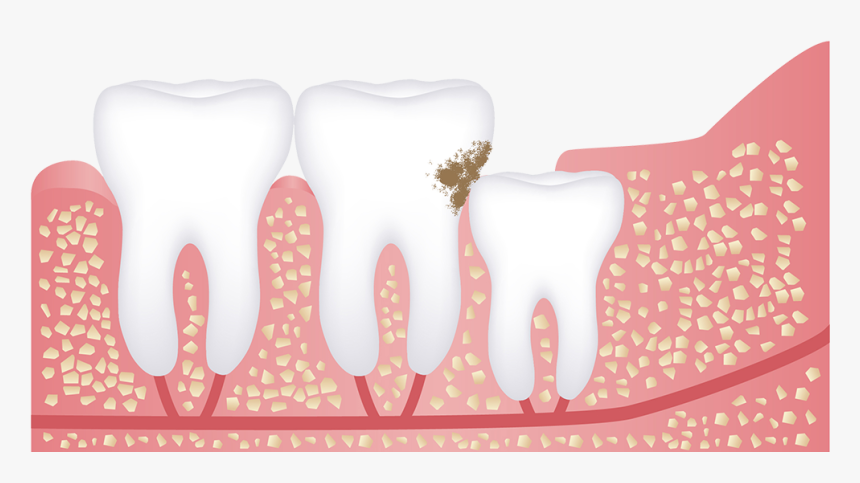 Wisdom Tooth Tooth Decay Transparent E1561524853641 - Impact Top Wisdom Tooth, HD Png Download, Free Download