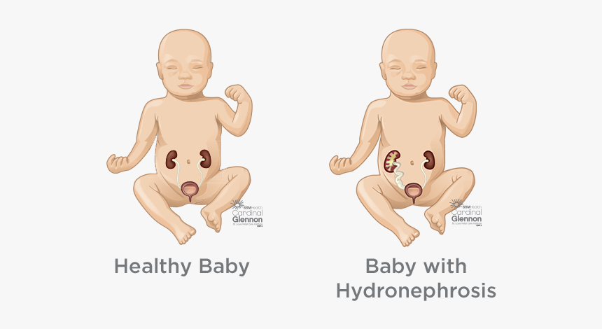 Hydronephrosis In Baby Boy, HD Png Download, Free Download