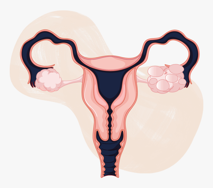 Pcos And Pregnancy - Ovarian Cancer Drawing, HD Png Download, Free Download