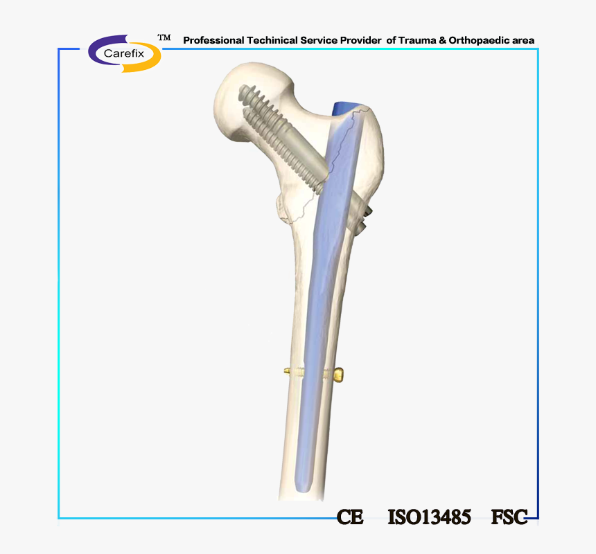 Carefix Femur And Tibia Interlocking Nail,metallic, HD Png Download, Free Download