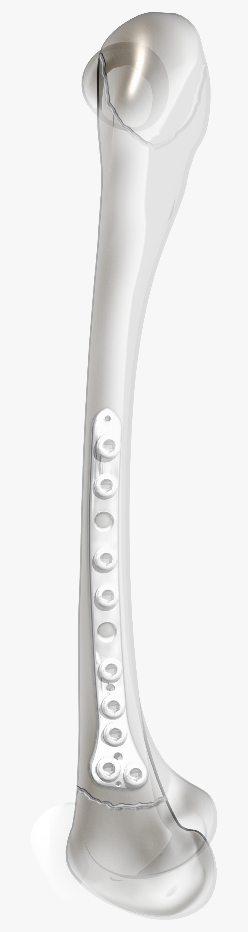 Contour Lateral - Pediatric Distal Femur Plate, HD Png Download, Free Download