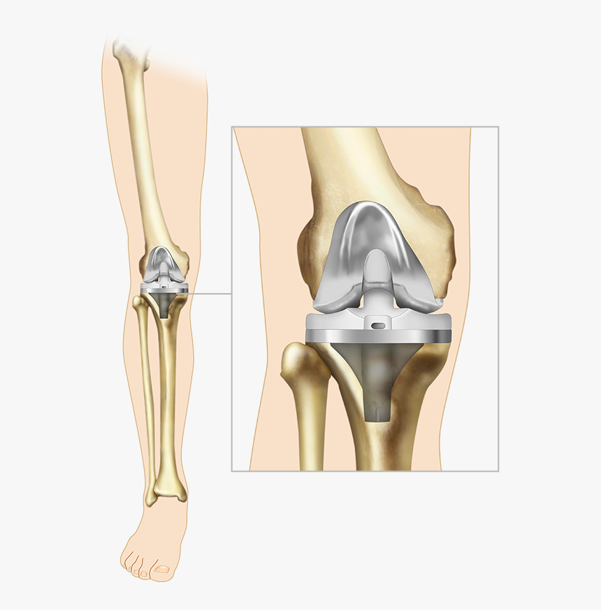 Knee Implant, HD Png Download, Free Download