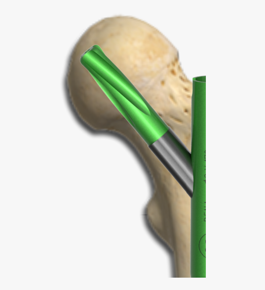 Helical Blade Femur Nail - Shovel, HD Png Download, Free Download