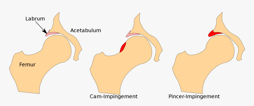 Cam Pincer Impingement Hüfte, HD Png Download, Free Download