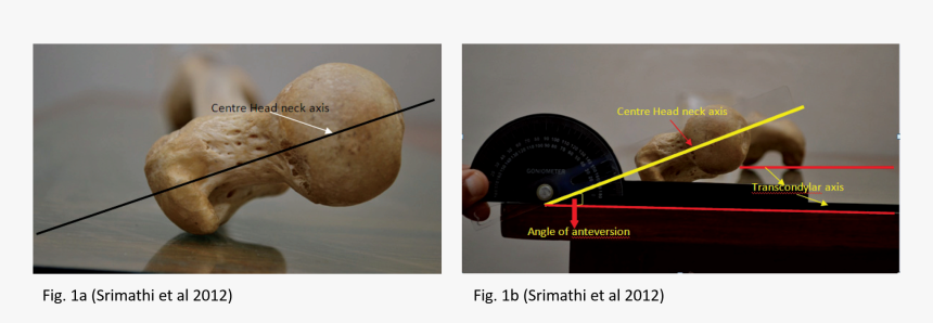 Anteversion And Antetorsion, HD Png Download, Free Download