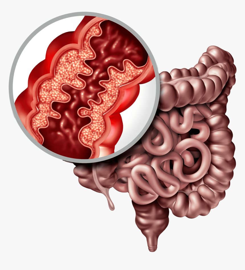 Crohns Disease Clipart, HD Png Download, Free Download