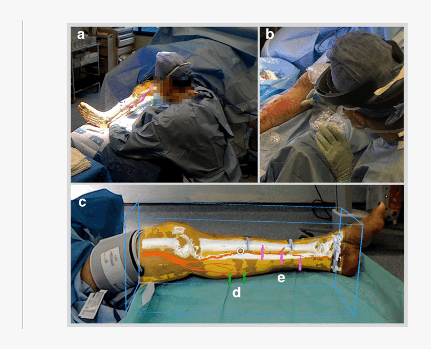A Case 3 Ar Overlay Of Models As Viewed From Remote - Augmented Reality Surgery, HD Png Download, Free Download