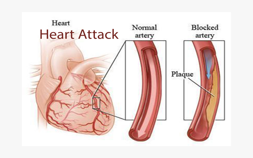 Heart Attack, Heart Attack - Blocked Coronary Artery, HD Png Download, Free Download