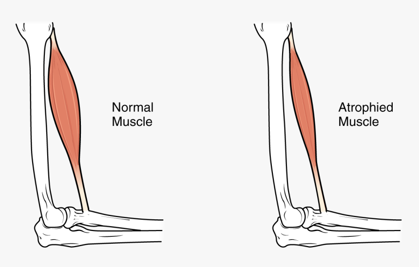 This Image Shows Muscle Atrophy - Muscles Atrophy, HD Png Download, Free Download